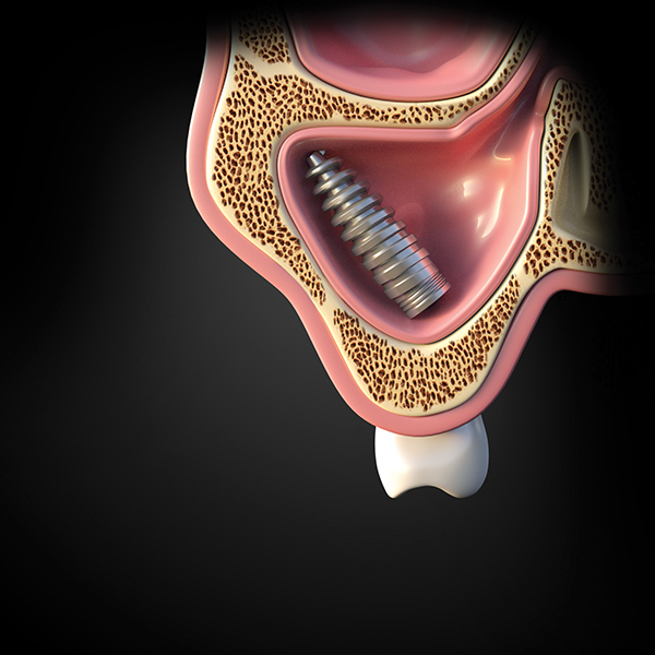can dental implants affect your sinuses