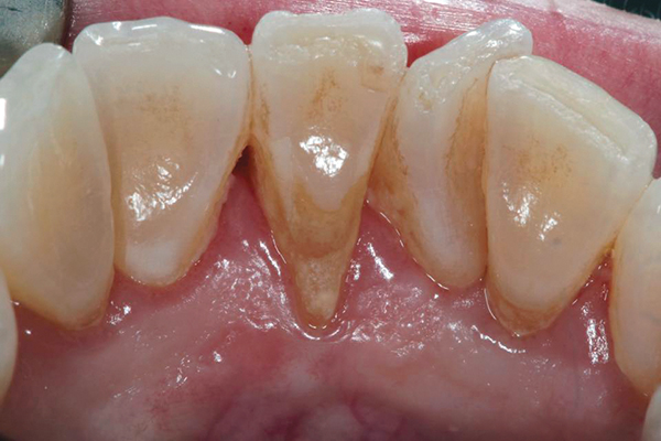 How do you know if a gum graft failed