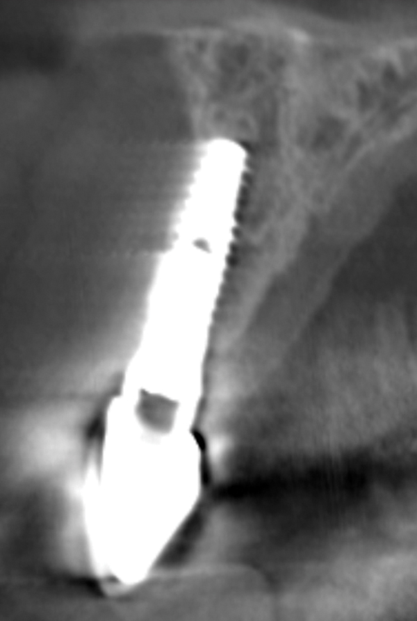 Tapered Versus Inverted Body Shift Implants Placed Into Anterior Post Extraction Sockets A Retrospective Comparative Study