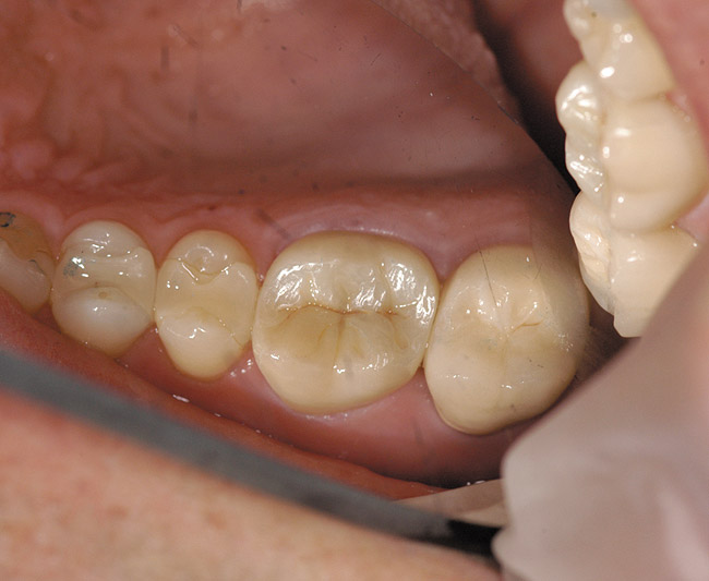 perspective Peephole policy Monolithic Zirconia Crowns and Bridges | January 2012 | Inside Dentistry