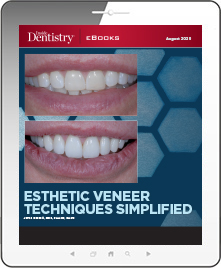 Esthetic Veneer Techniques Simplified Ebook Cover