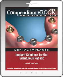 Implant Solutions for the Edentulous Patient Ebook Cover