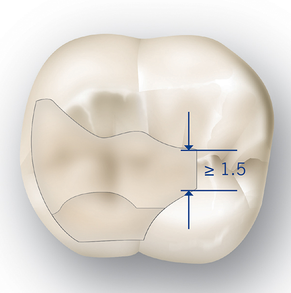 Conservation of Tooth Structure Utilizing Bonded Hybrid Ceramics