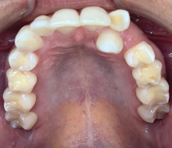 A Revolutionary Way to Move Teeth April 2021 Inside Dental Technology