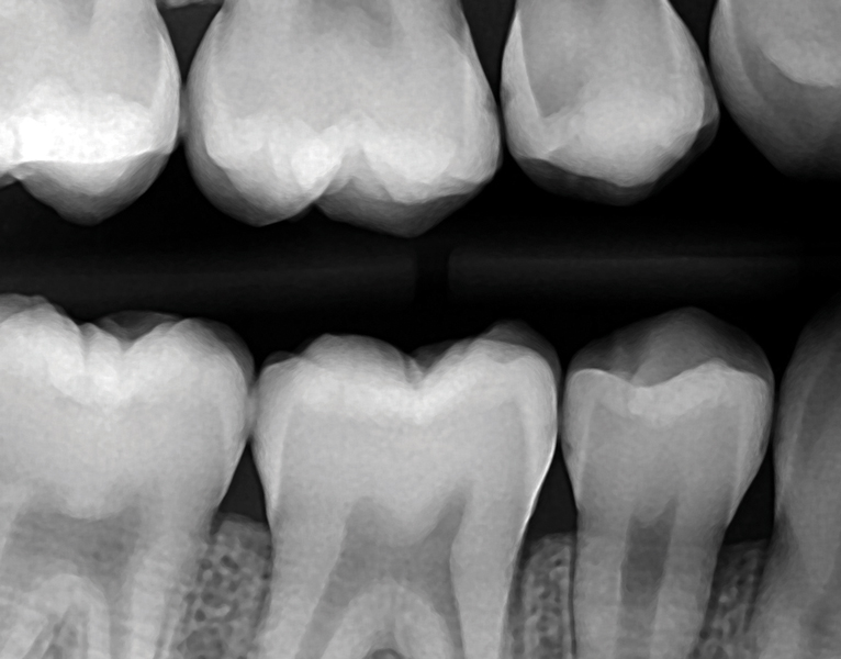 SDF for Managing Open Gingival Floor Margins in Class II Restorations