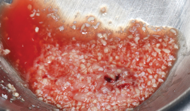 Adjunctive Use of Platelet Concentrates for Hard- and Soft-Tissue Grafting