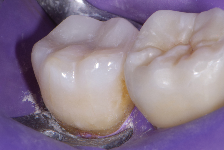 Updates in Direct Restorative