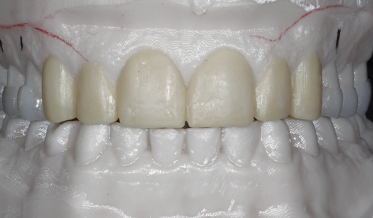 Comprehensive, Phased Restoration of Worn Dentition Utilizing Digital Analysis and Diagnostic Protocols