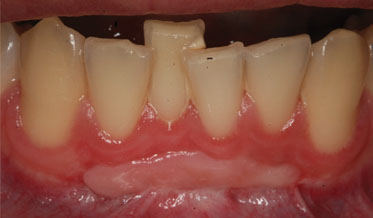 Periodontal Regeneration Therapy for Compromised Anterior Teeth