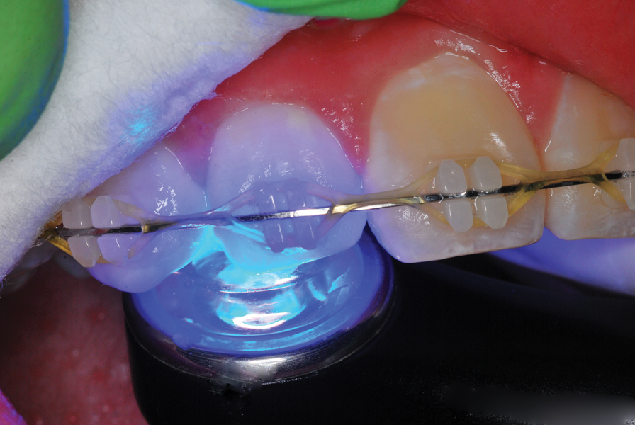 Dentist Fixes Braces with an Photopolymer Lamp in Dental Clinic