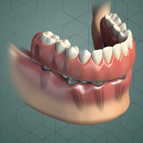 Planning Full-Arch Reconstructions for Today and Tomorrow: Implant Overdentures and Fixed Restorations Ebook Library Image