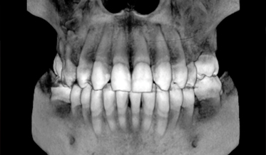 Contemporary Planning Tools for Restoration of Congenitally Missing Maxillary Lateral Incisors
