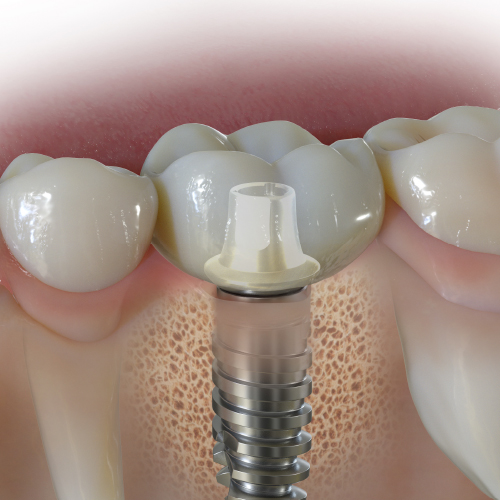 A Comprehensive Approach to Plan and Design the Emergence Profile Around Dental Implants Ebook Library Image