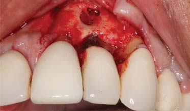 Repairing an Apical Lesion Around a Dental Implant