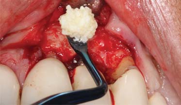 Repairing an Apical Lesion Around a Dental Implant