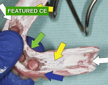 Properly Adjusting Implant-Retained Overdentures