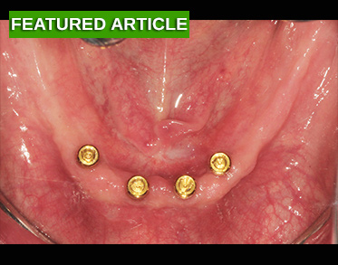 Properly Adjusting Implant-Retained Overdentures to Ensure Complete Adaptation