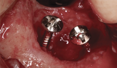 Ridge Augmentation in a Site of a Previous Implant Failure Using Tenting Screws With Allograft and Collagen Membrane