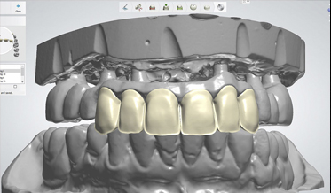 A Blended Prosthesis Design for an Implant-Supported Fixed Complete Denture to Manage Restricted Restorative Space
