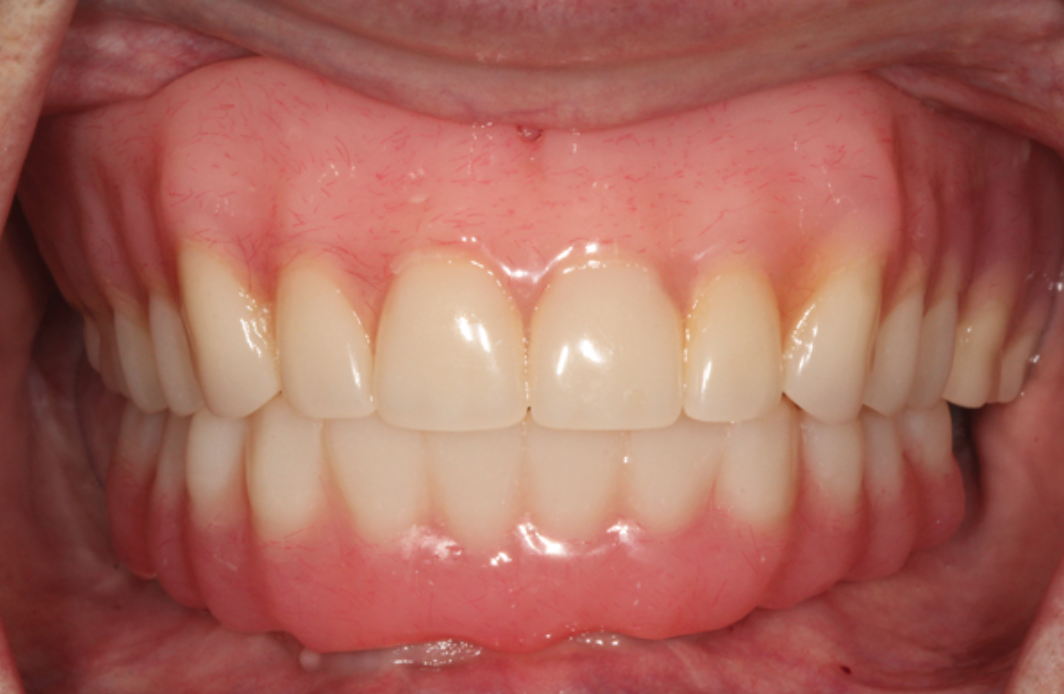 A ScrewFree Fixed Hybrid Prosthesis in Two Visits June 2021 Inside