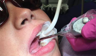 Preventing Caries in Partially Erupted Molars