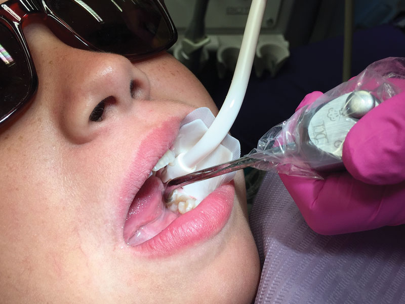 Preventing Caries in Partially Erupted Molars