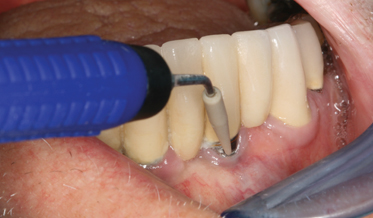 High Prevalence Rates of Peri-implant Mucositis and Peri-implantitis Post Dental Implantations Dictate Need for Continuous Peri-implant Maintenance
