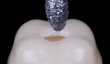 Preventing Porcelain Fractures During Endodontic Treatment