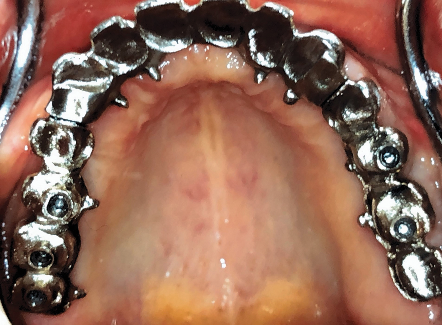 Long-Term Results of Maxillary Full-Arch Reconstruction Using Transitional Implants