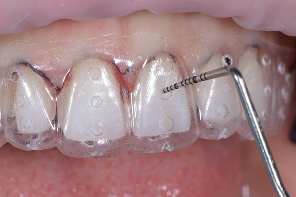 Maximizing Esthetics While Preserving Bone and Tooth Structure in a Young Adult Patient