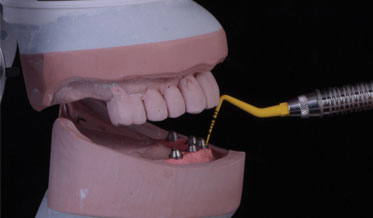 Choosing the Ideal Implant-Supported Prosthesis for an Edentulous Maxilla