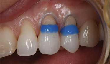Treating Noncarious Class V Lesions With Composite Bonding