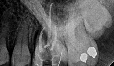 Management of Endodontic Infections: Prescribing Guidelines and the Risks of Clindamycin