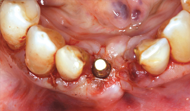 Utilization of Bioactive Dentin for Guided Bone Regeneration as Part of Implant Treatment