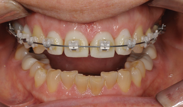 Correction of an Anteriorly Constricted/Deep Bite Through Orthodontics and Restorative Enhancements: A 3-Year Case Study
