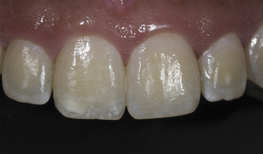 Minimally Invasive Esthetic Dentistry: Combination of Techniques to Mask White-Spot Lesions