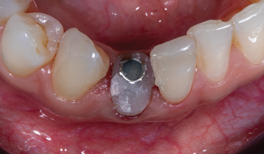 A Biologic Perspective on the Use of Partial Extraction Therapy in Implant Dentistry