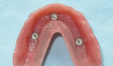 Bar-Retained Zygomatic Implant Overdenture as a First Line of Treatment