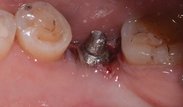 Repair of a Non-Retentive Crown Over a Press-Fit Implant Placed 30 Years Prior
