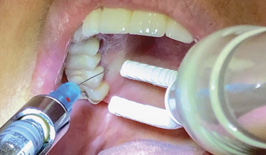 The Use and Benefits of Vibration as a Supplement to Conventional Local Anesthetic Injection