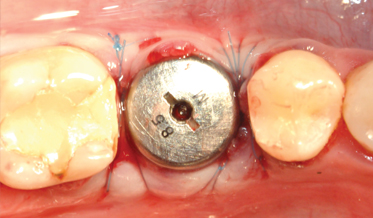 Osseodensification Effective for Immediate Molar Replacement