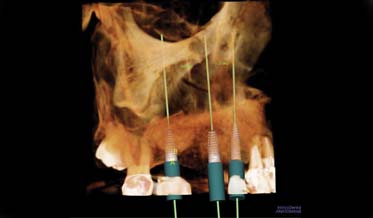 Tooth Replacement in the Maxillary Posterior