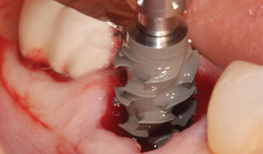 Single-Site Immediate Implant Placement and Restoration