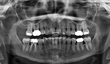 Correcting Occlusal Dysfunction While Addressing Patient’s Esthetic Concerns