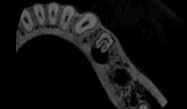 The Importance of Cone-Beam Computed Tomography in Endodontic Treatment of a Mandibular Premolar With Atypical Anatomy: A Case Report
