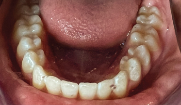 Making a Case for Adult Orthodontics With Clear Aligner Therapy Provided by the General Dentist