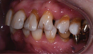 Comprehensive Restorative Dentistry With Super Translucent Zirconia