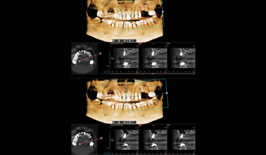 Layered Bone Grafting in Preparation for Dental Implants