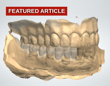 Adapting the Digital Reference Denture Technique for Full-Arch Cases Using a Novel Fixed Attachment System