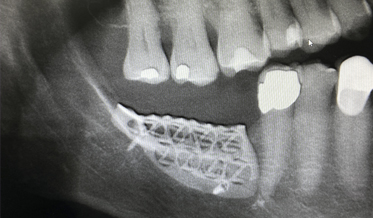 Mesh Ridge Augmentation Using CAD/CAM Technology for Design and Printing: Two Case Reports